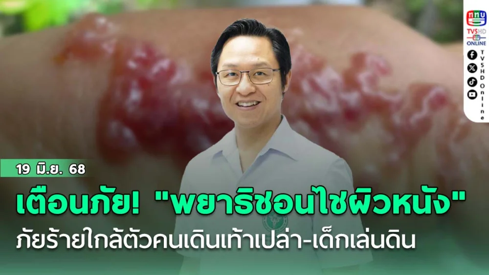 สถาบันโรคผิวหนัง เตือนภัย! "พยาธิชอนไชผิวหนัง" ภัยร้ายใกล้ตัวคนเดินเท้าเปล่า-เด็กเล่นดิน