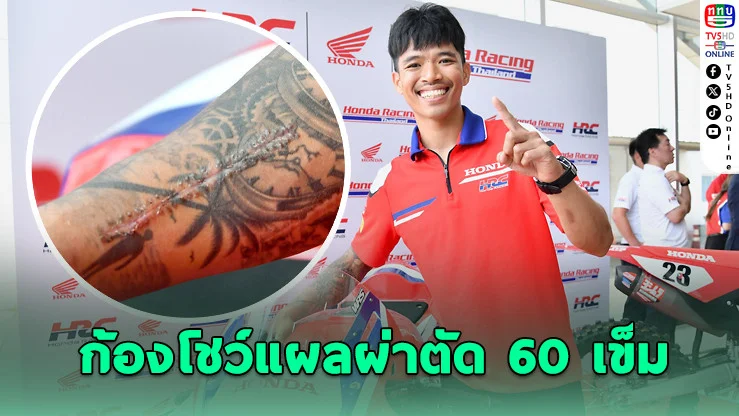 "ก้อง สมเกียรติ" ผ่าตัด 60 เข็ม ลุยซูเปอร์ไบค์โลก