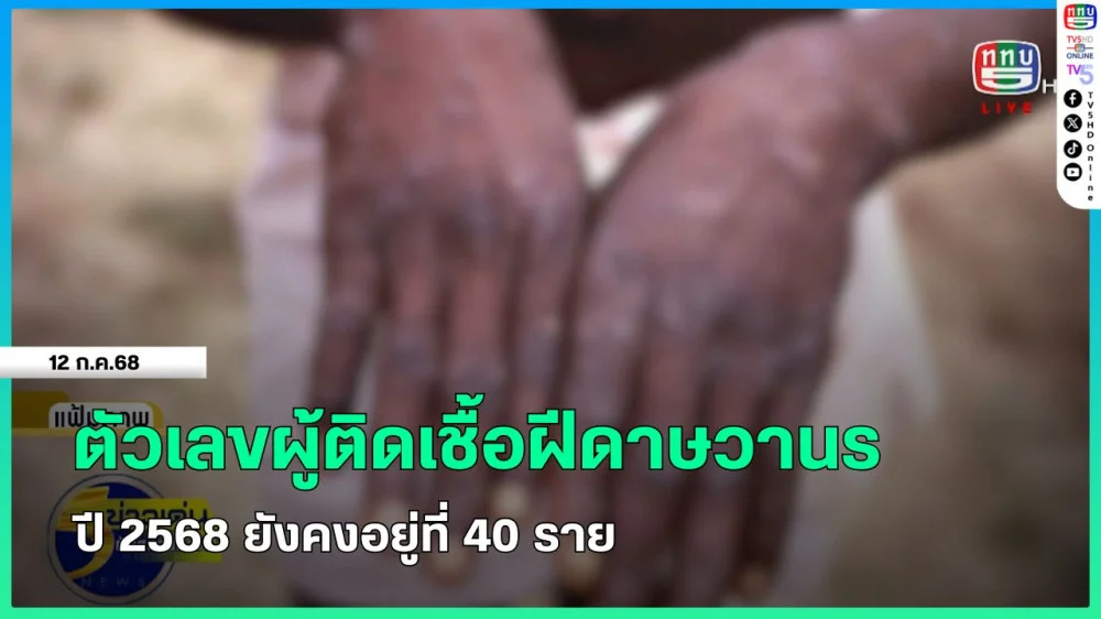 ตัวเลขผู้ติดเชื้อฝีดาษวานร ปี 2568 ยังคงอยู่ที่ 40 ราย