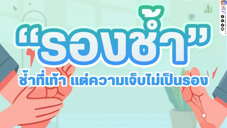 รู้จัก "รองช้ํา" ช้ําที่เท้า แต่ความเจ็บไม่เป็นรอง