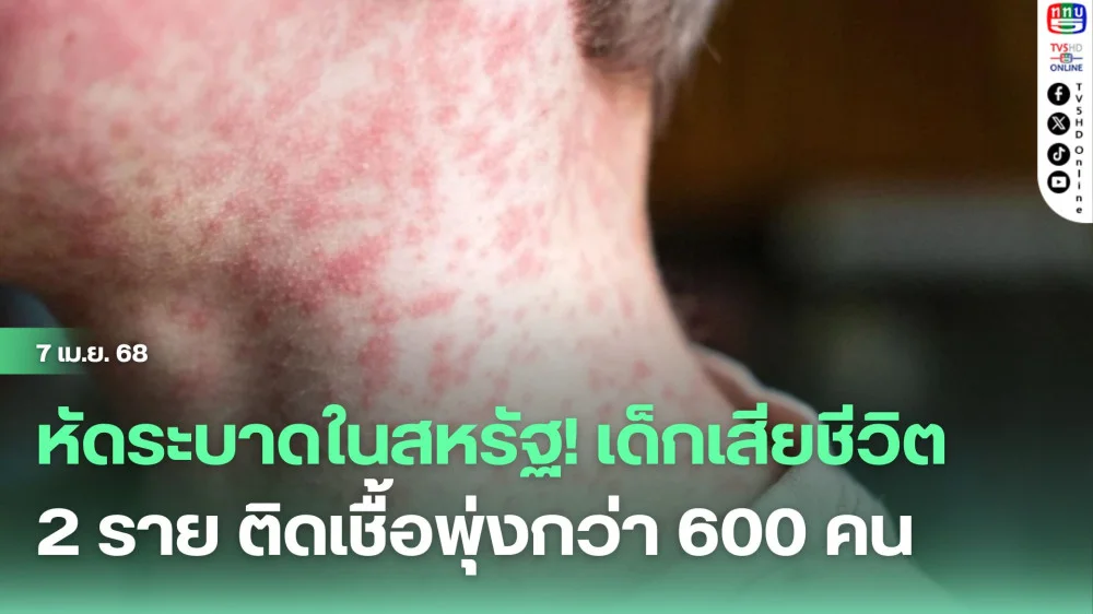 หัดระบาดในสหรัฐ! เด็กเสียชีวิต 2 ราย ติดเชื้อพุ่งกว่า 600 คน