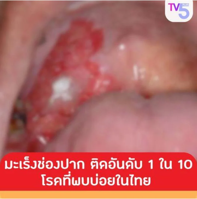 มะเร็งช่องปากเป็นโรคที่ติดอันดับ 1 ใน 10 ที่พบได้บ่อยในประเทศไทย
