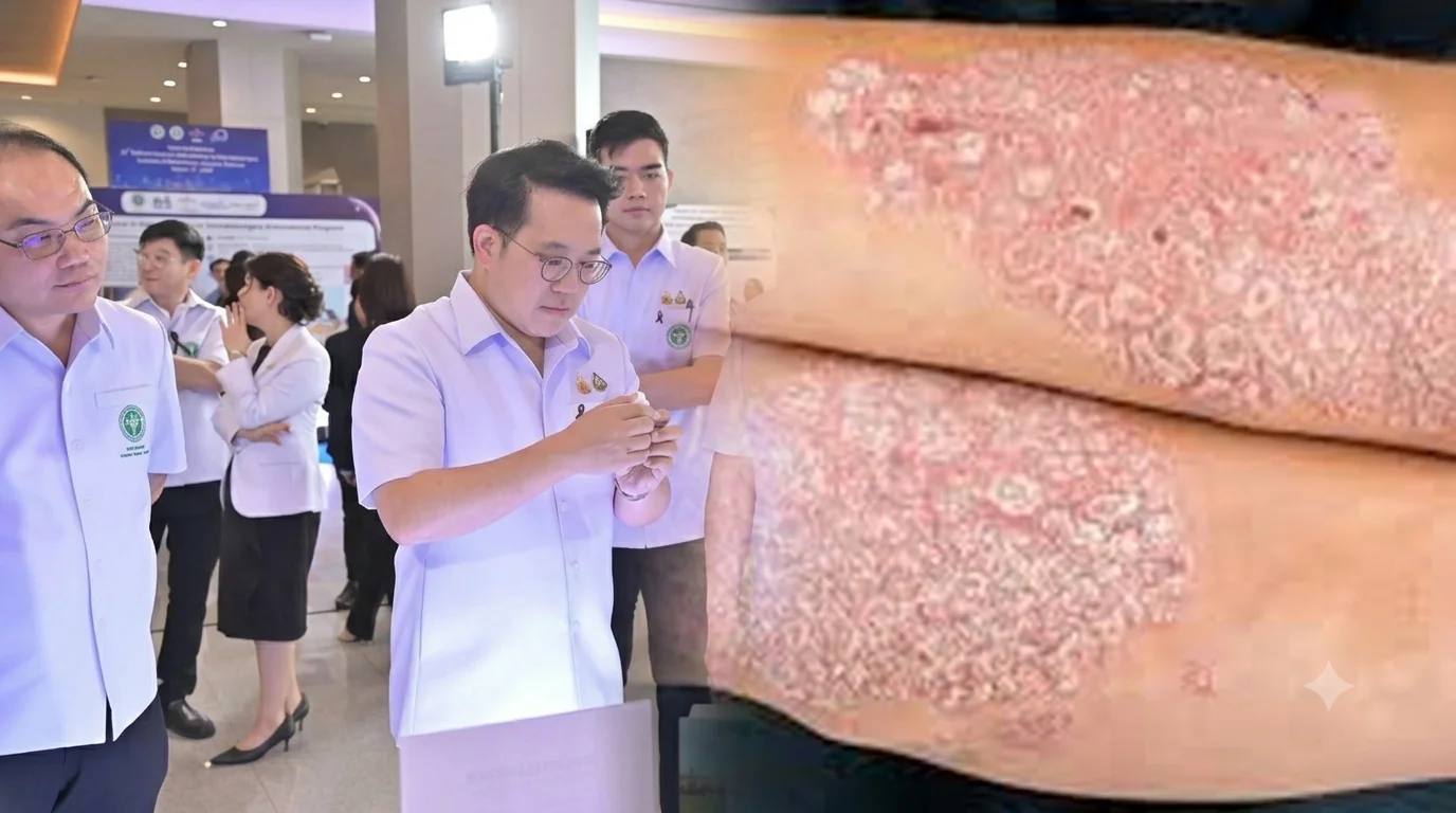 สธ. เปิดตัว AI Psoriasis